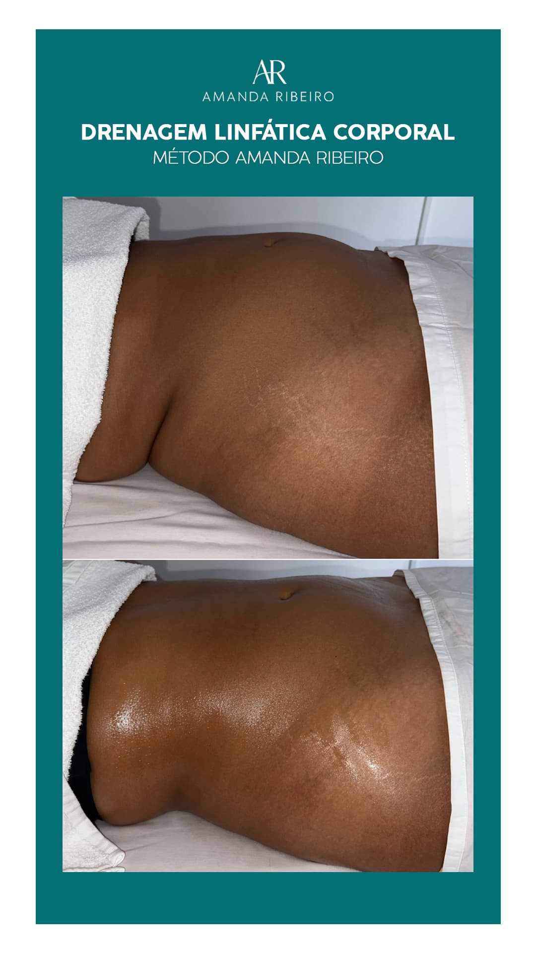 Resultado antes e depois - Drenagem Linfática