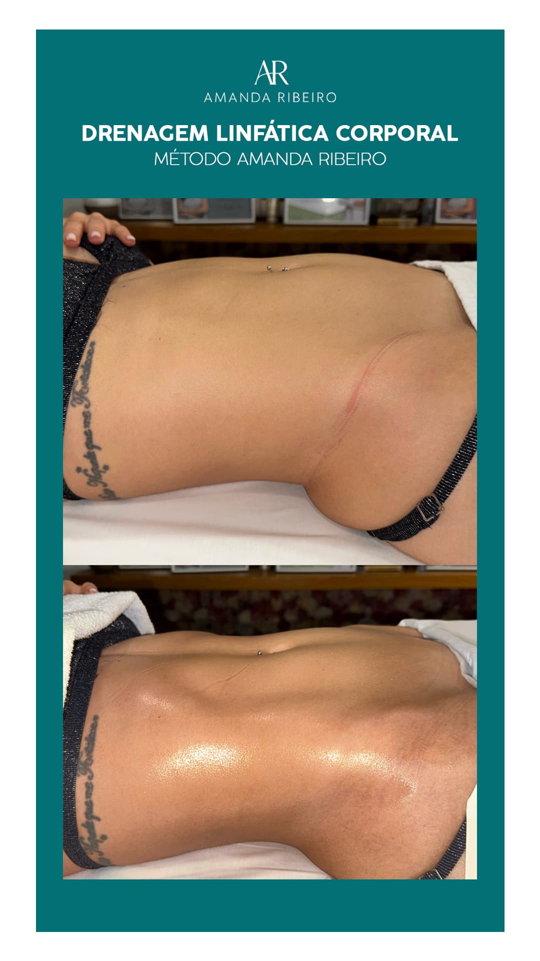 Resultado antes e depois - Drenagem Linfática