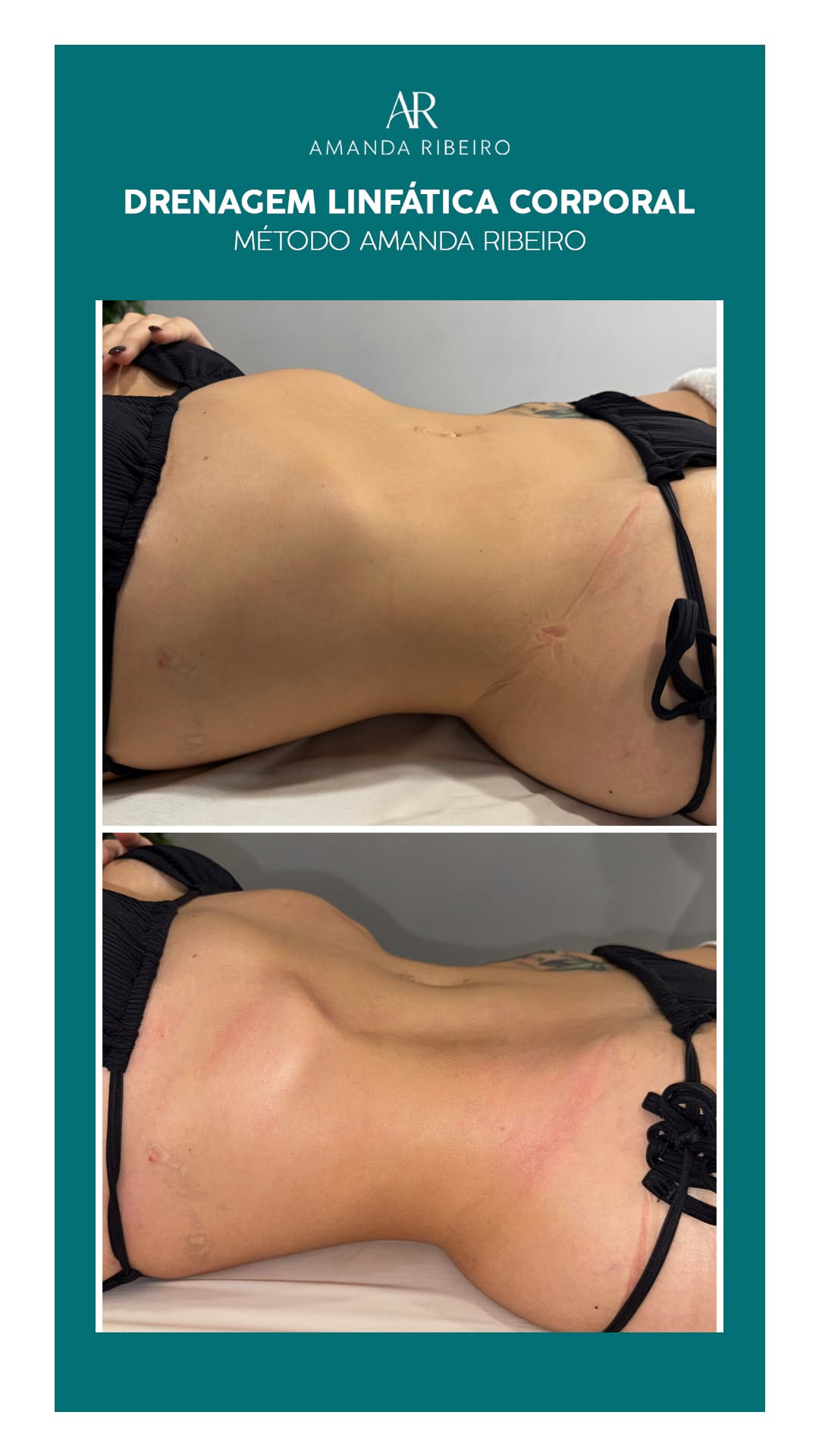 Resultado antes e depois - Drenagem Linfática