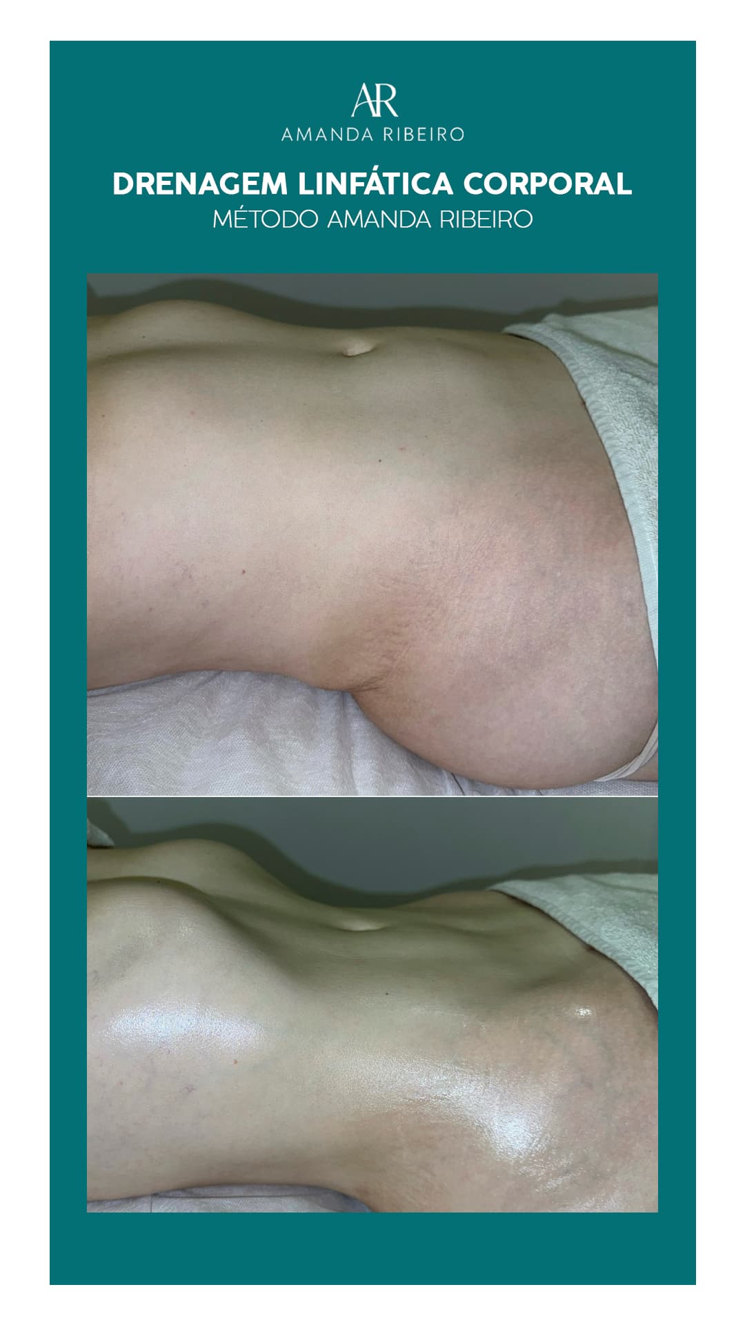 Resultado antes e depois - Drenagem Linfática