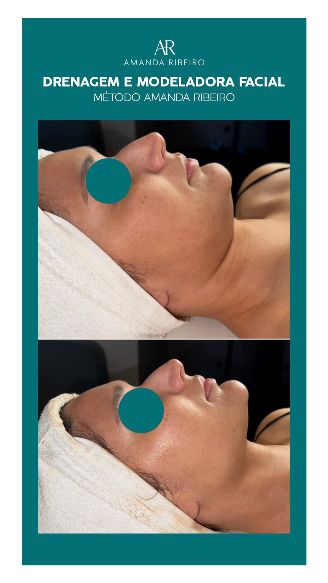 Resultado antes e depois - Drenagem Facial