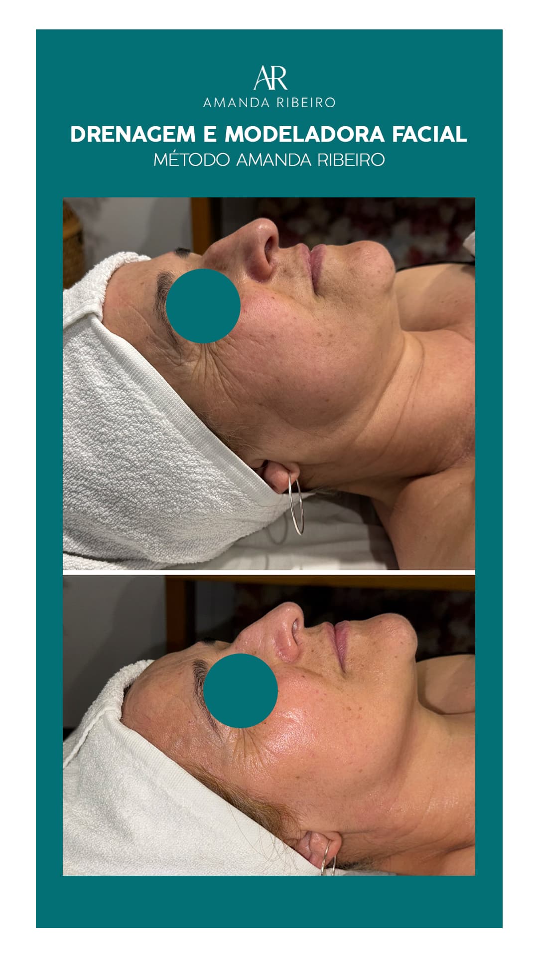 Resultado antes e depois - Drenagem Facial