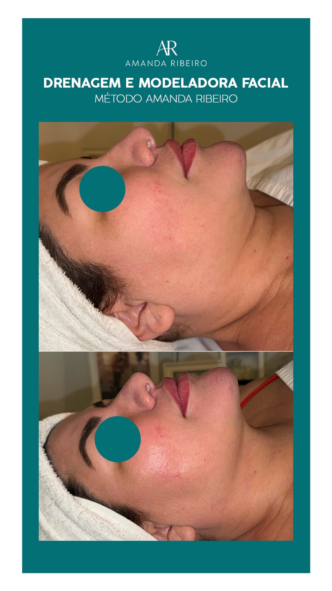 Resultado antes e depois - Drenagem Facial